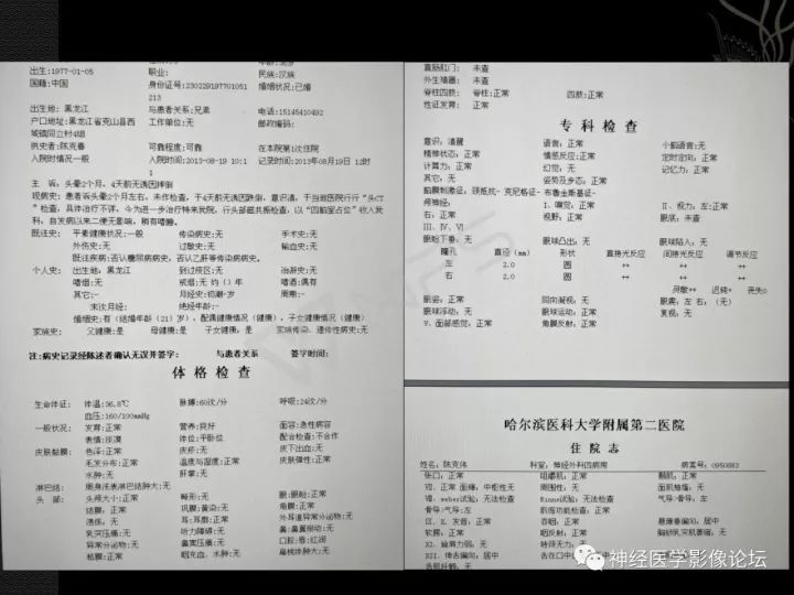 【病例】菊形团形成性胶质神经元肿瘤1例CT及MR表现 【病例】菊形团形成性胶质神经元肿瘤1例CT及MR表现