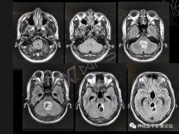 【病例】菊形团形成性胶质神经元肿瘤1例CT及MR表现 【病例】菊形团形成性胶质神经元肿瘤1例CT及MR表现