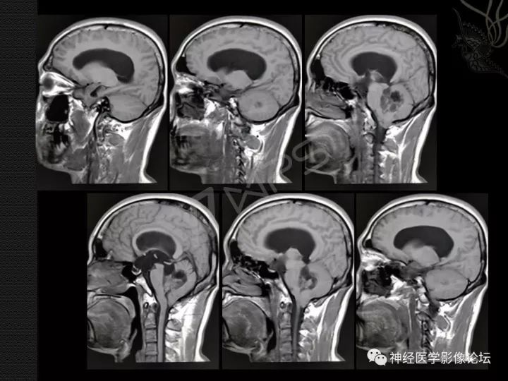 【病例】菊形团形成性胶质神经元肿瘤1例CT及MR表现 【病例】菊形团形成性胶质神经元肿瘤1例CT及MR表现