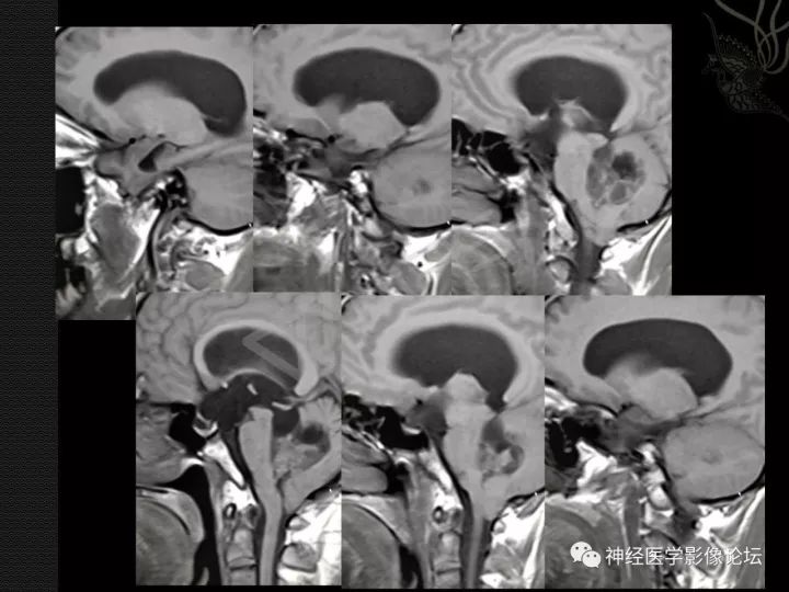 【病例】菊形团形成性胶质神经元肿瘤1例CT及MR表现 【病例】菊形团形成性胶质神经元肿瘤1例CT及MR表现