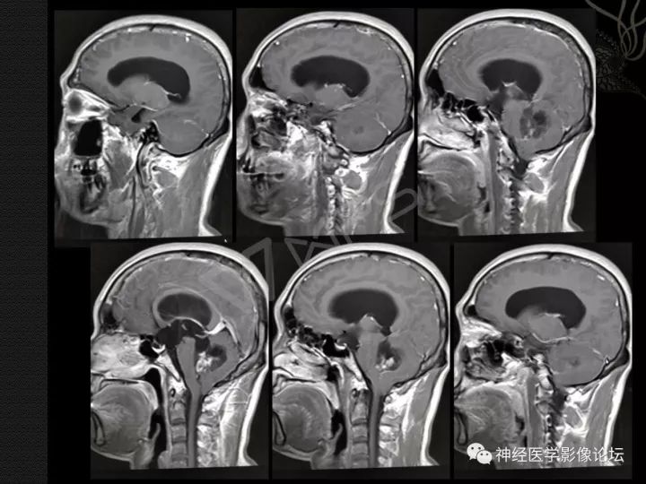 【病例】菊形团形成性胶质神经元肿瘤1例CT及MR表现 【病例】菊形团形成性胶质神经元肿瘤1例CT及MR表现