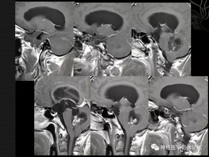 【病例】菊形团形成性胶质神经元肿瘤1例CT及MR表现 【病例】菊形团形成性胶质神经元肿瘤1例CT及MR表现
