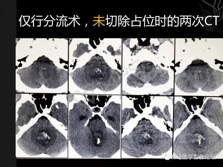 【病例】菊形团形成性胶质神经元肿瘤1例CT及MR表现 【病例】菊形团形成性胶质神经元肿瘤1例CT及MR表现