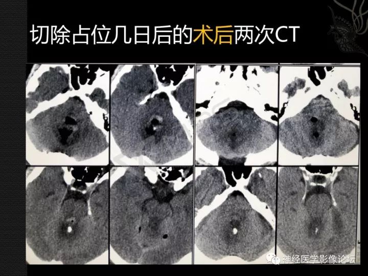 【病例】菊形团形成性胶质神经元肿瘤1例CT及MR表现 【病例】菊形团形成性胶质神经元肿瘤1例CT及MR表现