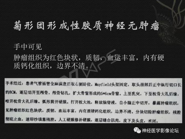 【病例】菊形团形成性胶质神经元肿瘤1例CT及MR表现 【病例】菊形团形成性胶质神经元肿瘤1例CT及MR表现