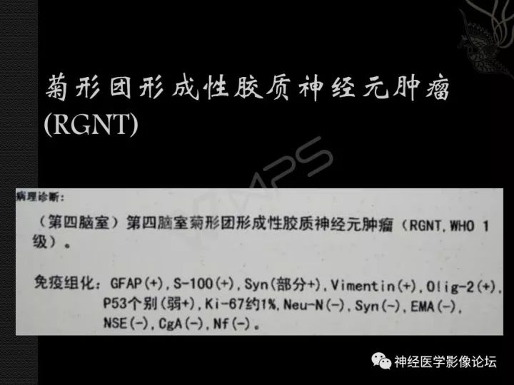 【病例】菊形团形成性胶质神经元肿瘤1例CT及MR表现 【病例】菊形团形成性胶质神经元肿瘤1例CT及MR表现