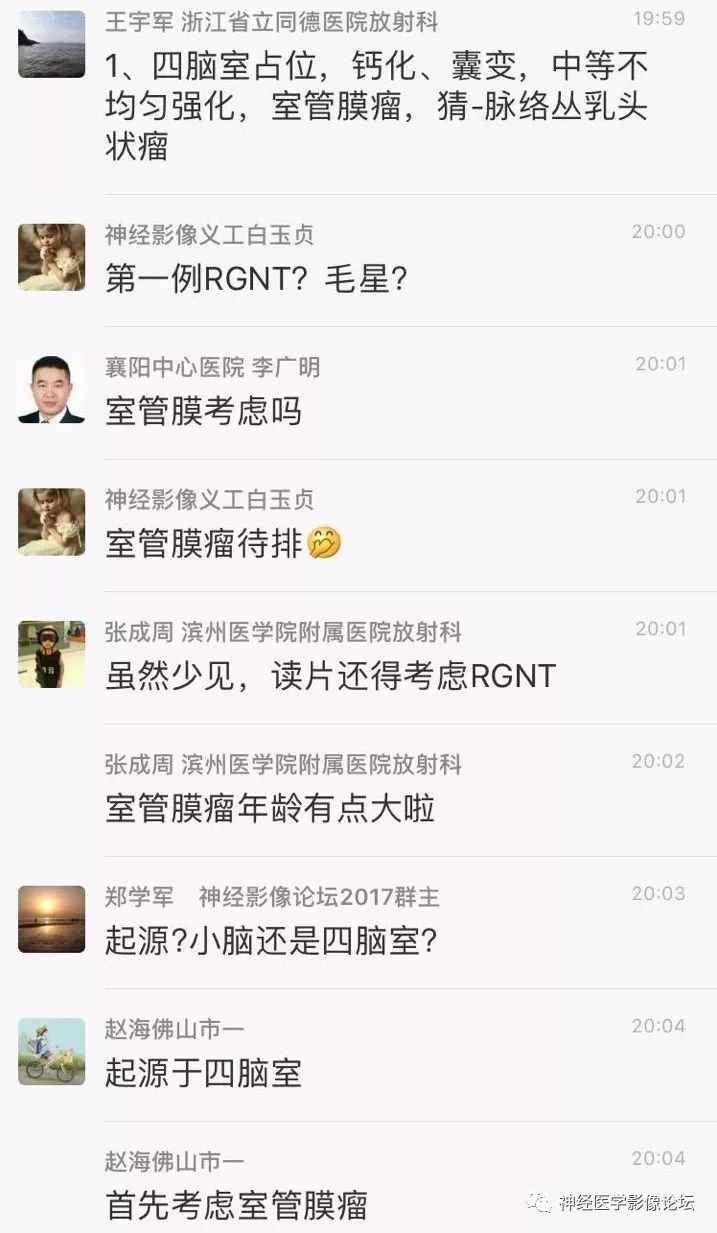 【病例】菊形团形成性胶质神经元肿瘤1例CT及MR表现 【病例】菊形团形成性胶质神经元肿瘤1例CT及MR表现