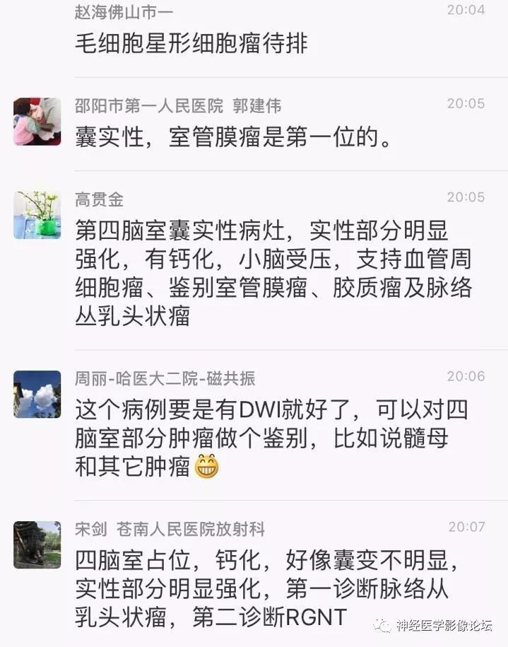 【病例】菊形团形成性胶质神经元肿瘤1例CT及MR表现 【病例】菊形团形成性胶质神经元肿瘤1例CT及MR表现
