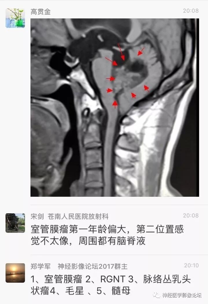 【病例】菊形团形成性胶质神经元肿瘤1例CT及MR表现 【病例】菊形团形成性胶质神经元肿瘤1例CT及MR表现