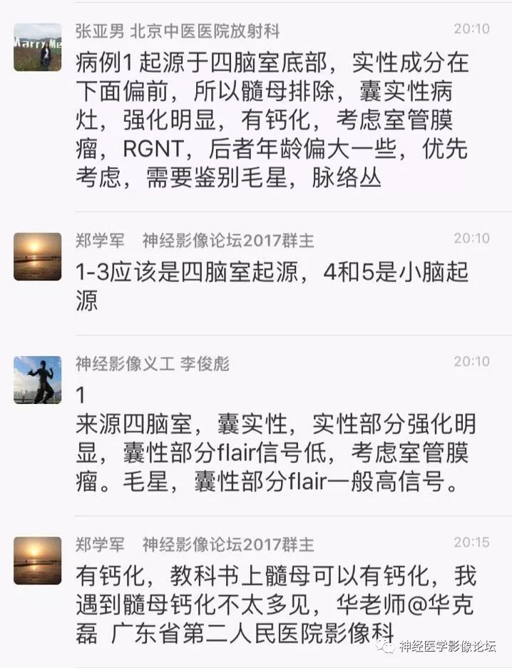 【病例】菊形团形成性胶质神经元肿瘤1例CT及MR表现 【病例】菊形团形成性胶质神经元肿瘤1例CT及MR表现