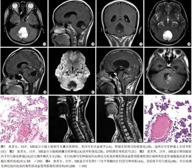 【病例】菊形团形成性胶质神经元肿瘤1例CT及MR表现 【病例】菊形团形成性胶质神经元肿瘤1例CT及MR表现