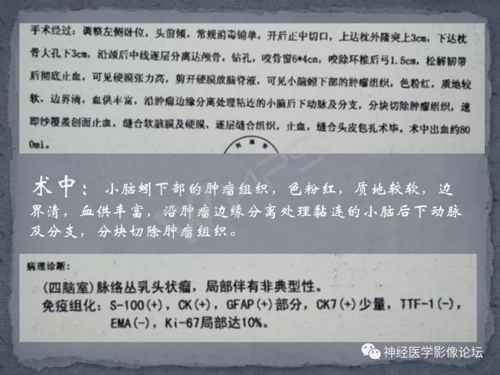 【病例】四脑室脉络丛乳头状瘤一例MR