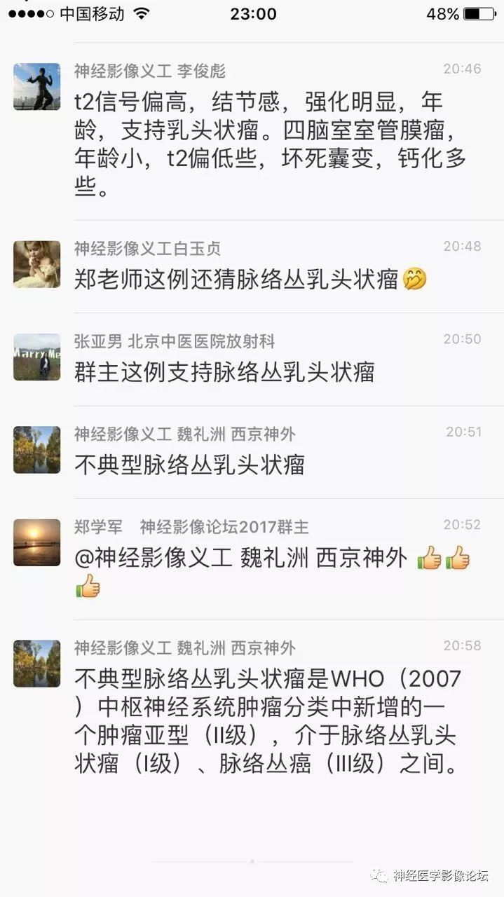 【病例】四脑室脉络丛乳头状瘤一例MR