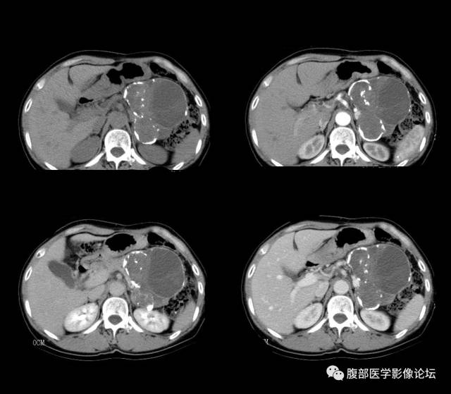 【病例】胰腺神经内分泌肿瘤1例CT影像表现