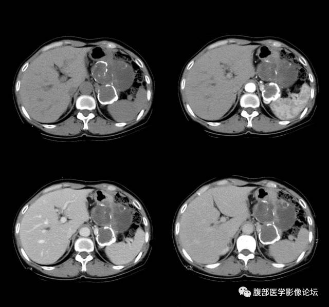 【病例】胰腺神经内分泌肿瘤1例CT影像表现 【病例】胰腺神经内分泌肿瘤1例CT影像表现