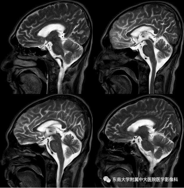 【病例】脑桥中央髓鞘溶解症1例MR