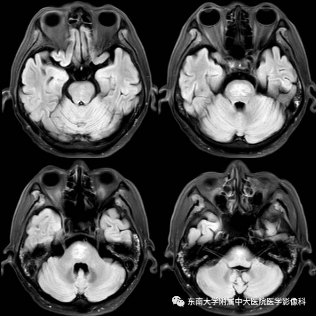 【病例】脑桥中央髓鞘溶解症1例MR