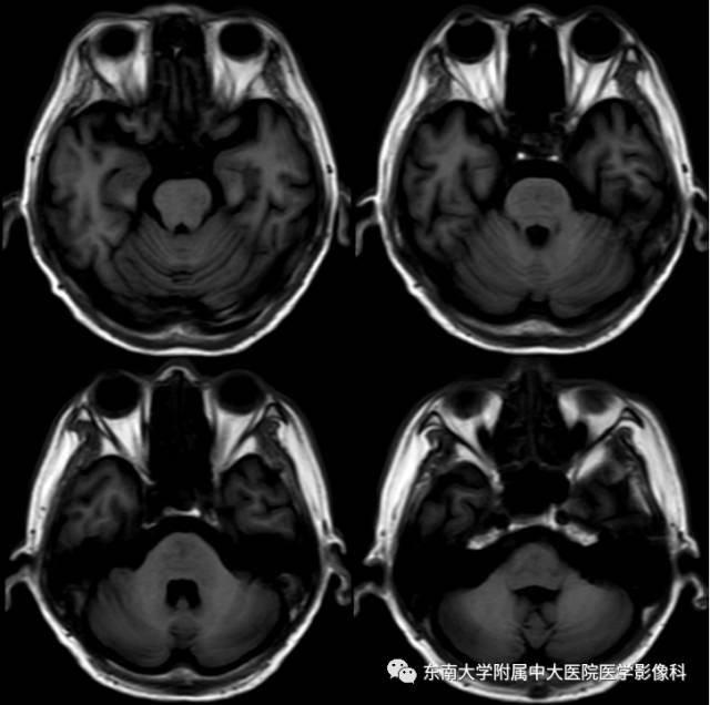 【病例】脑桥中央髓鞘溶解症1例MR