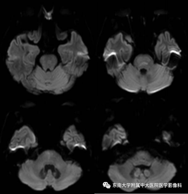 【病例】脑桥中央髓鞘溶解症1例MR