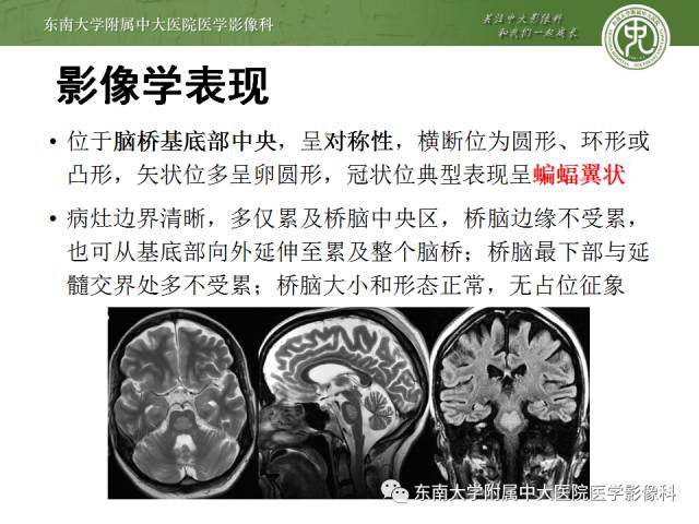 【病例】脑桥中央髓鞘溶解症1例MR