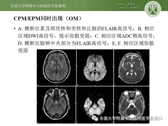 【病例】脑桥中央髓鞘溶解症1例MR