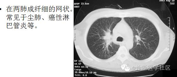 3分钟读懂胸片上肺纹理的改变