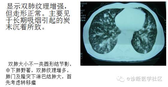 3分钟读懂胸片上肺纹理的改变