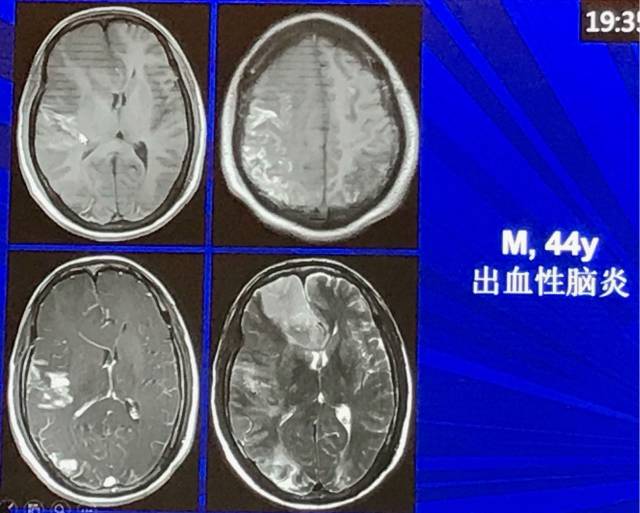 磁共振短T1信号的6种颅内病变 磁共振短T1信号的6种颅内病变