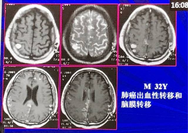 磁共振短T1信号的6种颅内病变 磁共振短T1信号的6种颅内病变