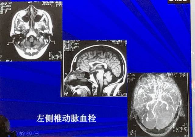 磁共振短T1信号的6种颅内病变 磁共振短T1信号的6种颅内病变