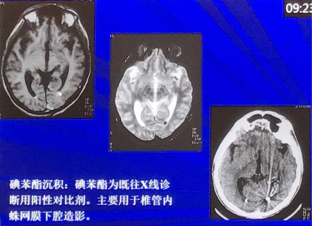 磁共振短T1信号的6种颅内病变 磁共振短T1信号的6种颅内病变