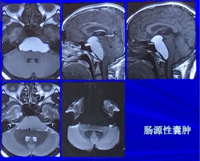 磁共振短T1信号的6种颅内病变 磁共振短T1信号的6种颅内病变