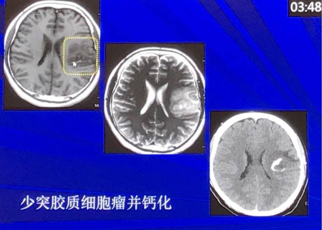 磁共振短T1信号的6种颅内病变 磁共振短T1信号的6种颅内病变