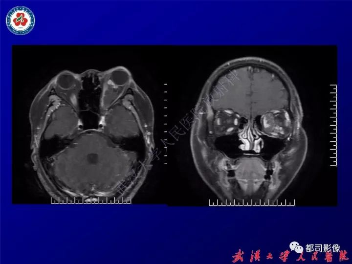 【病例】眼眶淋巴管瘤1例MR影像诊断