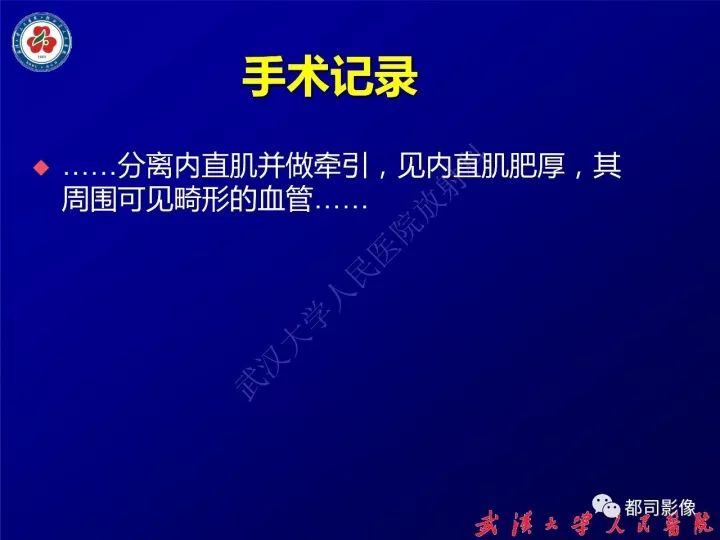 【病例】眼眶淋巴管瘤1例MR影像诊断