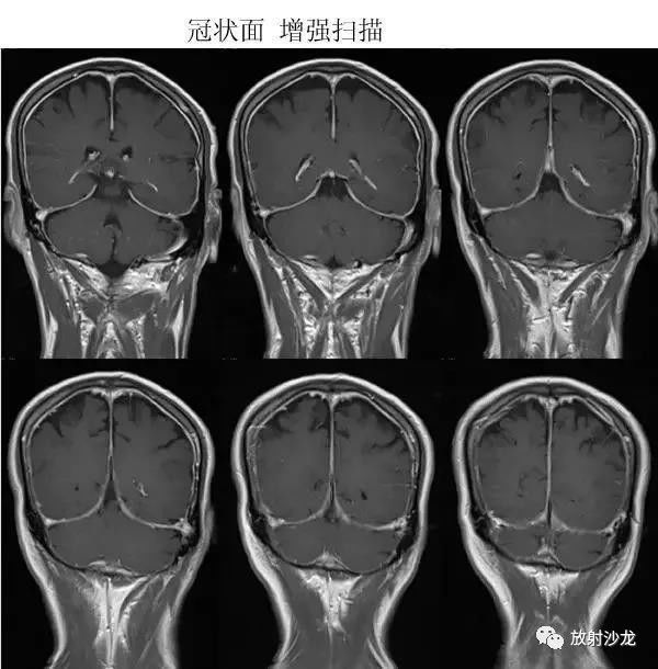 极易误诊的自发性低颅压综合征