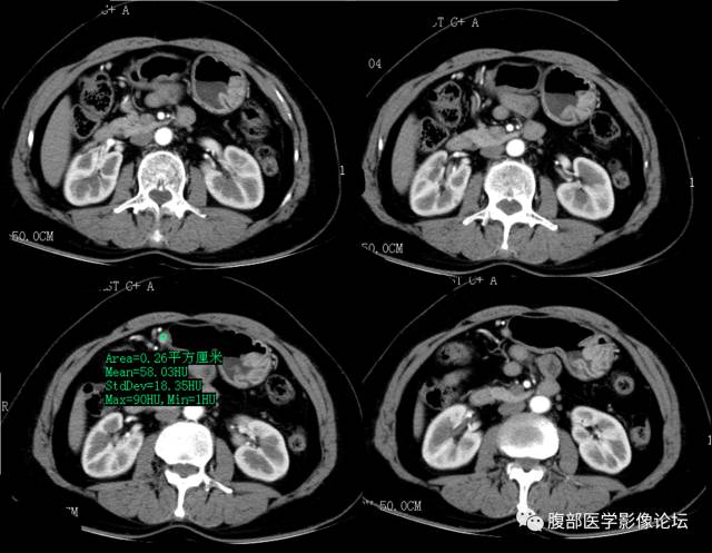 【病例】胃大弯血管球瘤1例CT 【病例】胃大弯血管球瘤1例CT