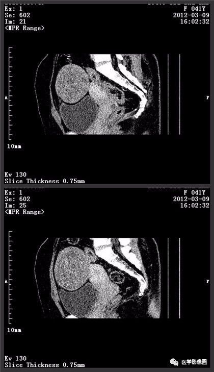 【病例】卵巢颗粒细胞瘤1例CT影像表现 【病例】卵巢颗粒细胞瘤1例CT影像表现