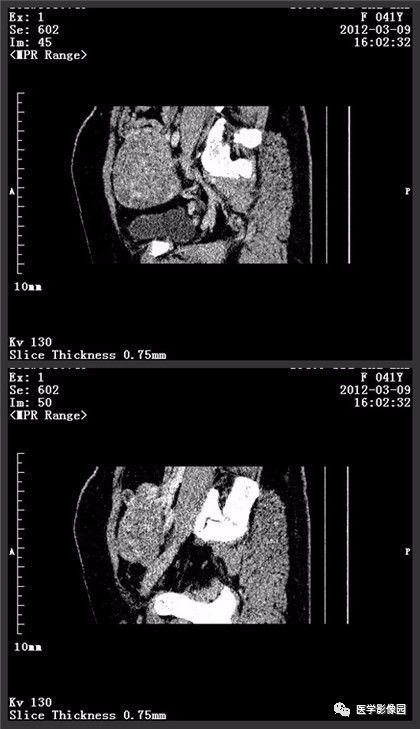 【病例】卵巢颗粒细胞瘤1例CT影像表现 【病例】卵巢颗粒细胞瘤1例CT影像表现