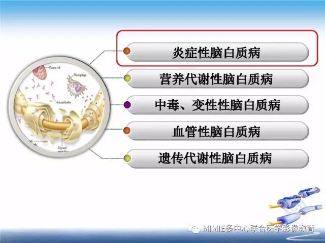 【PPT】中枢神经系统脱髓鞘疾病