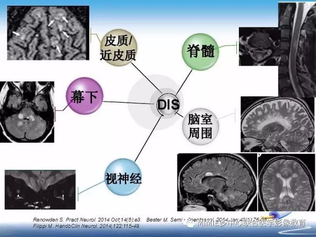 【PPT】中枢神经系统脱髓鞘疾病