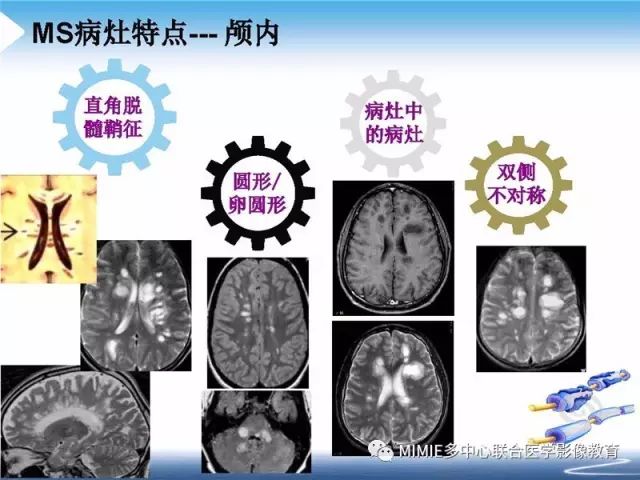 【PPT】中枢神经系统脱髓鞘疾病