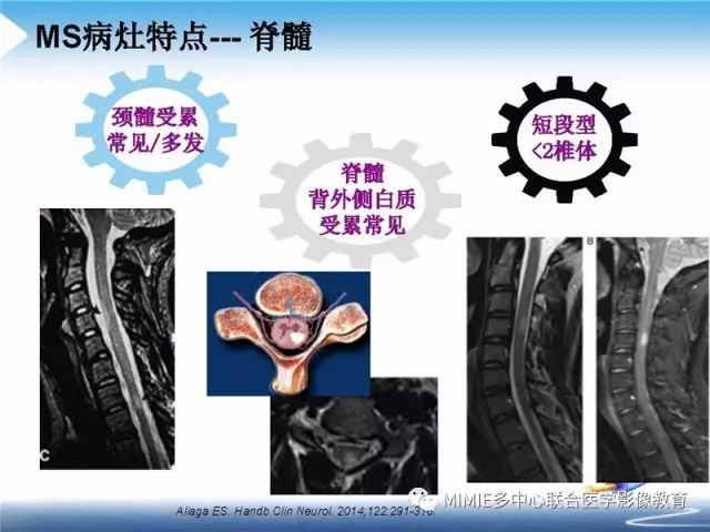 【PPT】中枢神经系统脱髓鞘疾病