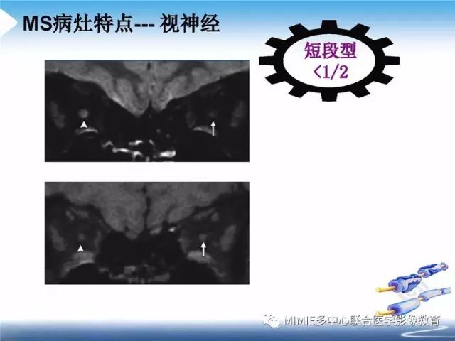 【PPT】中枢神经系统脱髓鞘疾病