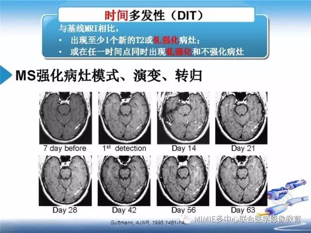 【PPT】中枢神经系统脱髓鞘疾病