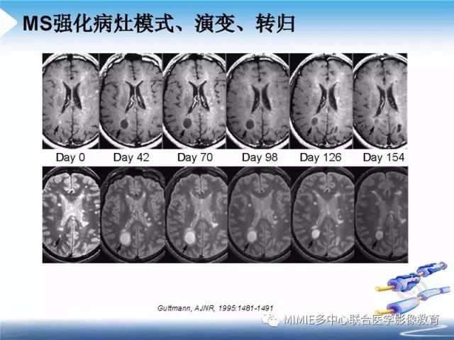 【PPT】中枢神经系统脱髓鞘疾病