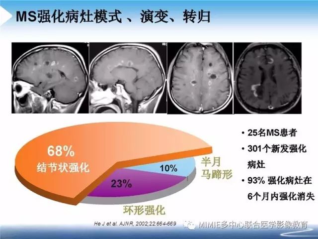【PPT】中枢神经系统脱髓鞘疾病