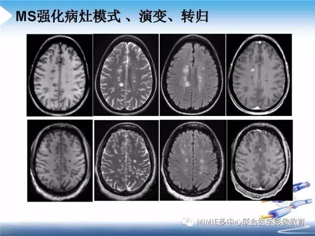 【PPT】中枢神经系统脱髓鞘疾病