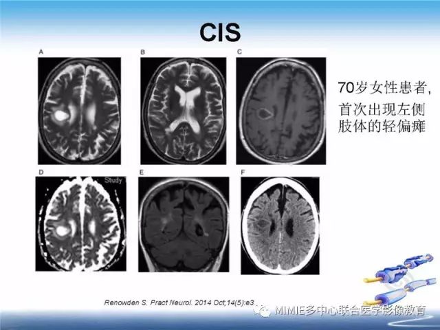 【PPT】中枢神经系统脱髓鞘疾病