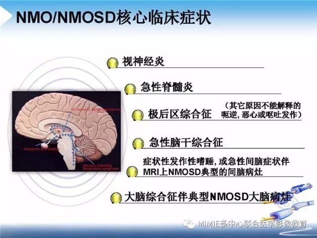 【PPT】中枢神经系统脱髓鞘疾病